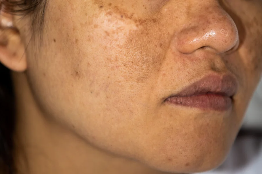 Pigmentation