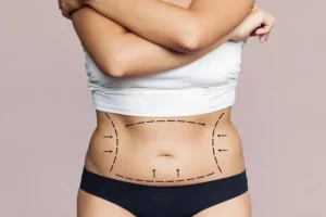 Tummy Tuck